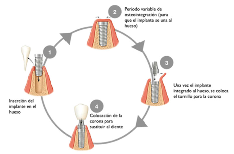 cirugia bucal