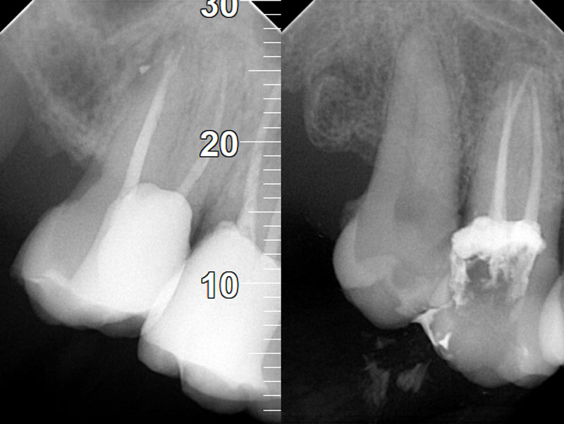 endodoncia